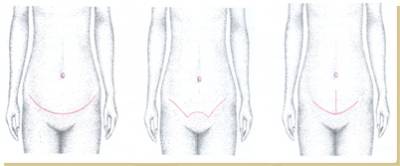 Абдоминопластика техника операции схема